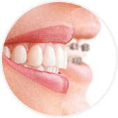 Comparación de dentaduras con ortodoncia invisible Invisalign y con ortodoncia tradicional